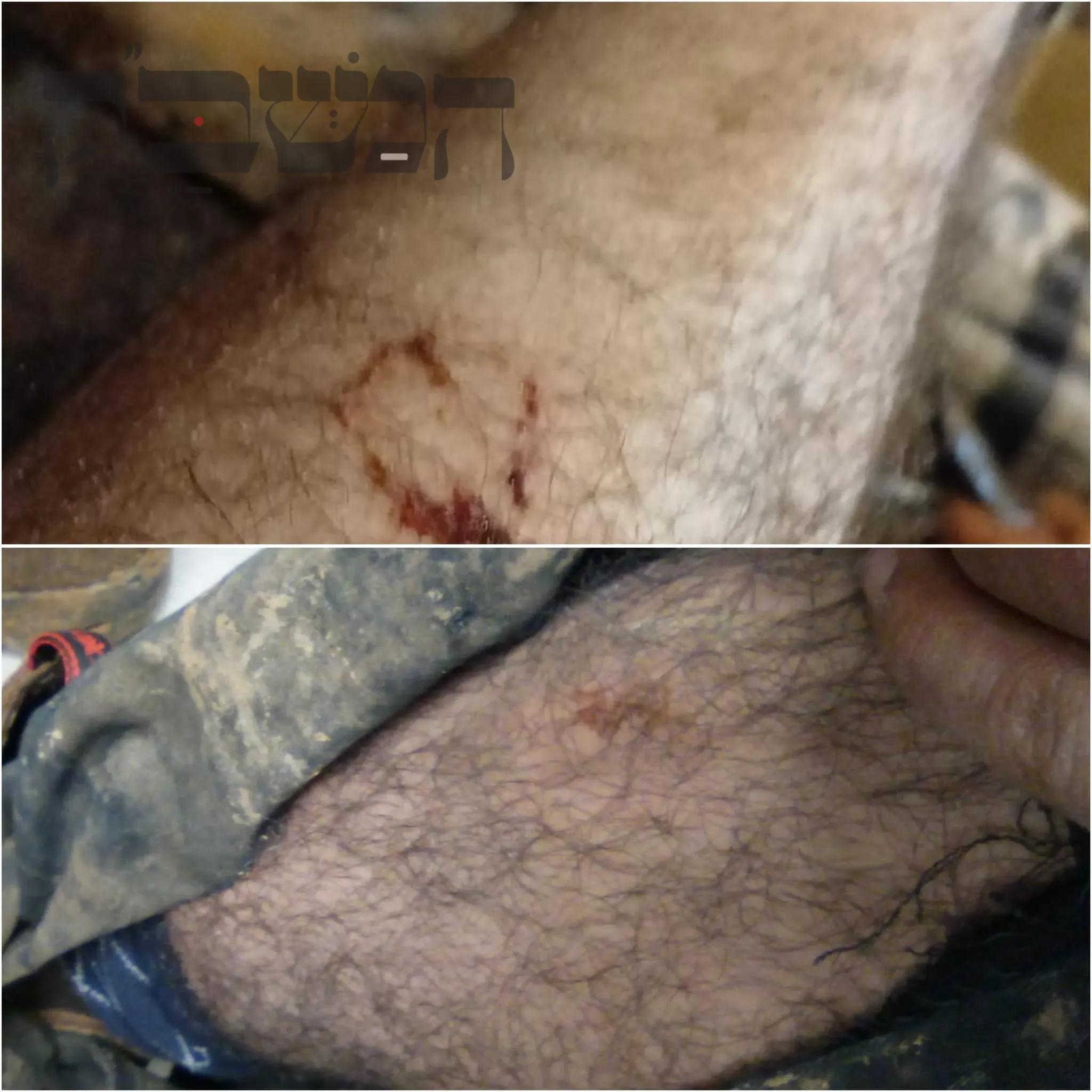 הפציעות של המתיישבים