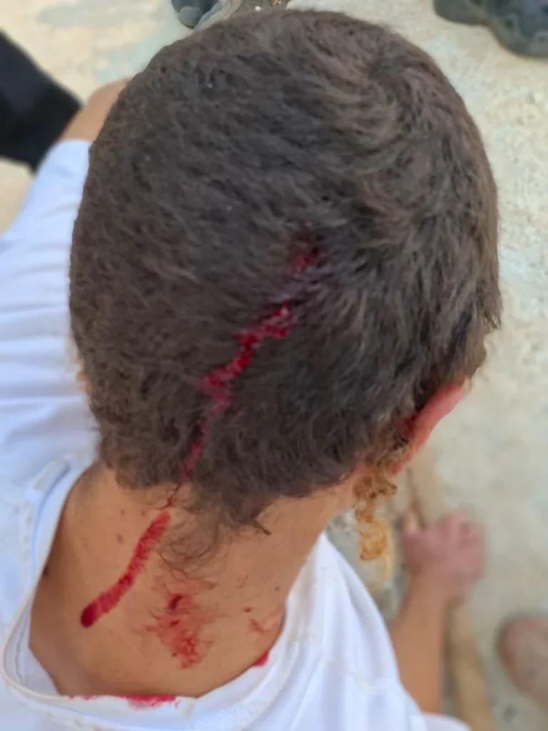 נער נפצע בראשו במתקפת של מאות פורעים ואנרכיסטים בבנימין